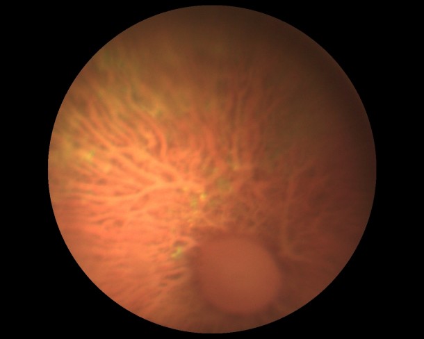 Глаукомная оптическая нейропатия