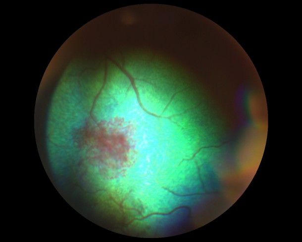 Гипертензивная ретинопатия кошек