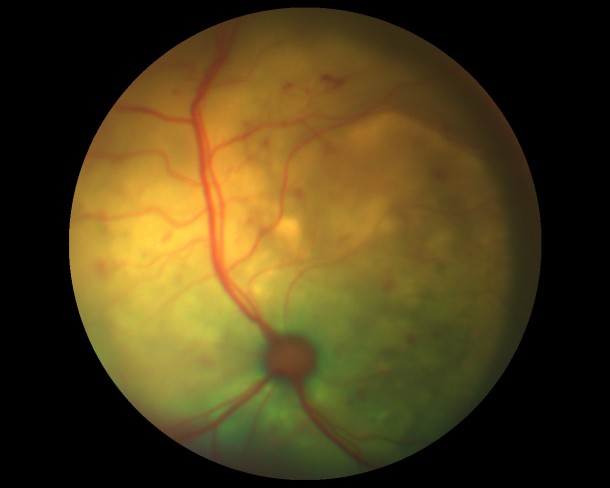 Гипертензивная ретинопатия кошек