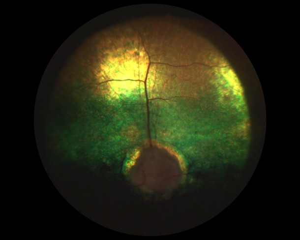 Глаукомная оптическая нейропатия