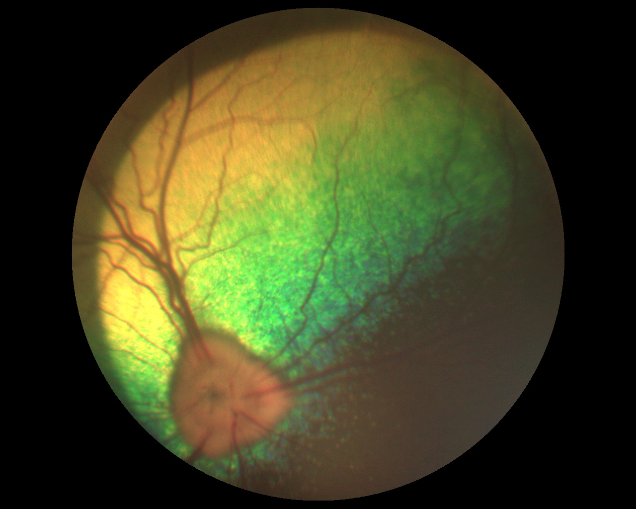 Нейропатия зрительных. Офтальмоскопия диска зрительного нерва. Офтальмоскопия сетчатки. Отслойка сетчатки офтальмоскопически. Тапеторетинальная абиотрофия сетчатки.